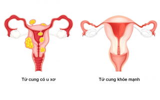 U xơ tử cung: Dấu hiệu, nguyên nhân và giải pháp từ Nga Phụ Khang