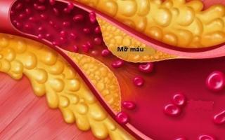 Đông y hỗ trợ điều trị rối loạn mỡ máu